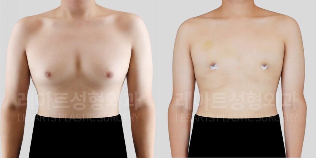 Gynecomastia surgery in Korea: daily life and T-shirt fit 2 weeks after surgery