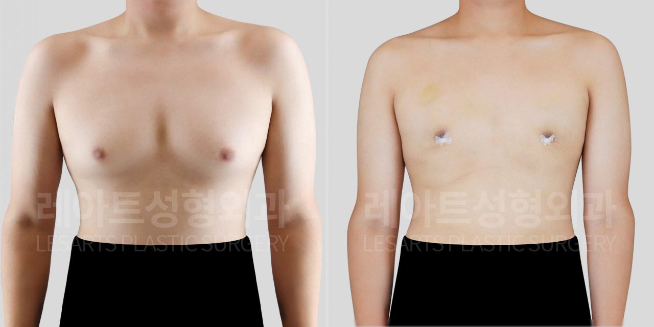 lesarts gynecomastia before and after