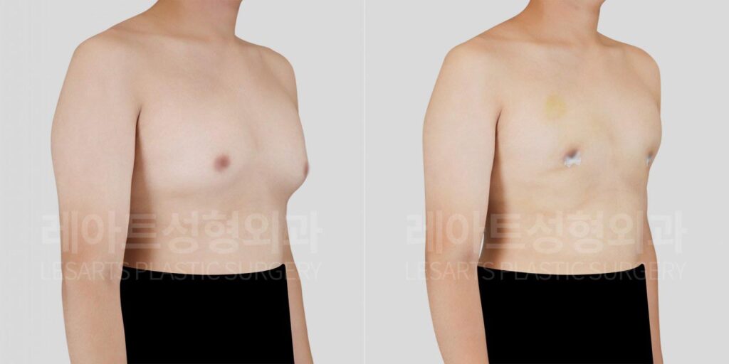 gynecomastia-02-05-260812
