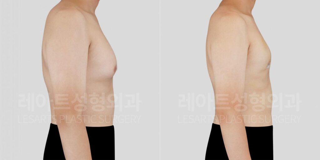 gynecomastia-02-06-260812