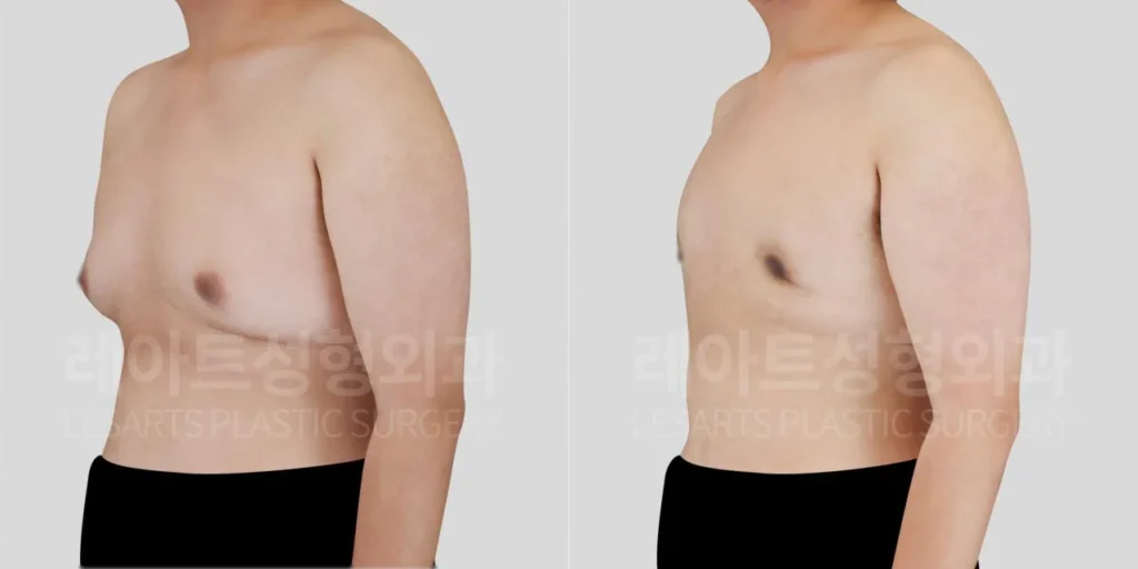 gynecomastia-02-06-260818