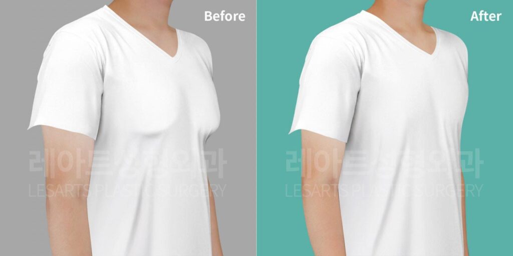 gynecomastia-02-08-260812