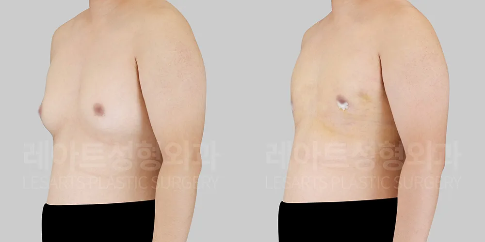 Gynecomastia – Simon Grade 2b: 2-Week Results After Surgery