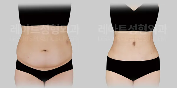 abdominoplasty-01-thumbnail-260824