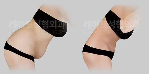 abdominoplasty-01-thumbnail-260827
