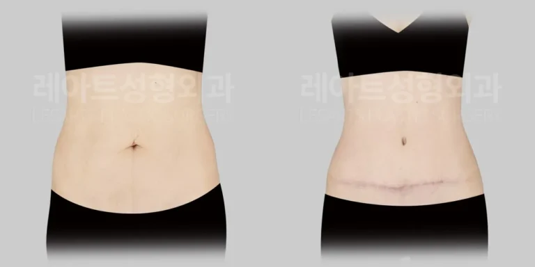 abdominoplasty-02-02-260819