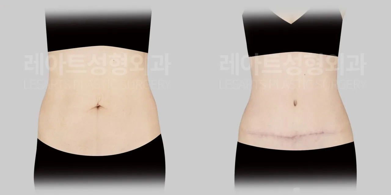 abdominoplasty-02-02-260819