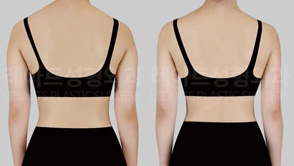 arm-liposuction-01-thumbnail-260826