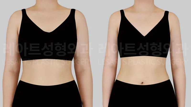 arm-liposuction-01-thumbnail-260827