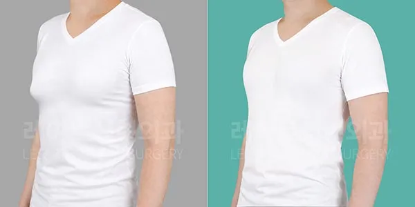 gynecomastia-01-thumbnail-260825