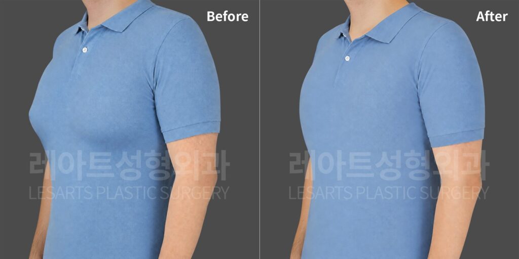 Gynecomastia surgery in Seoul: chest protrusion in a man in his 40s, from ultrasound diagnosis to 2-week results