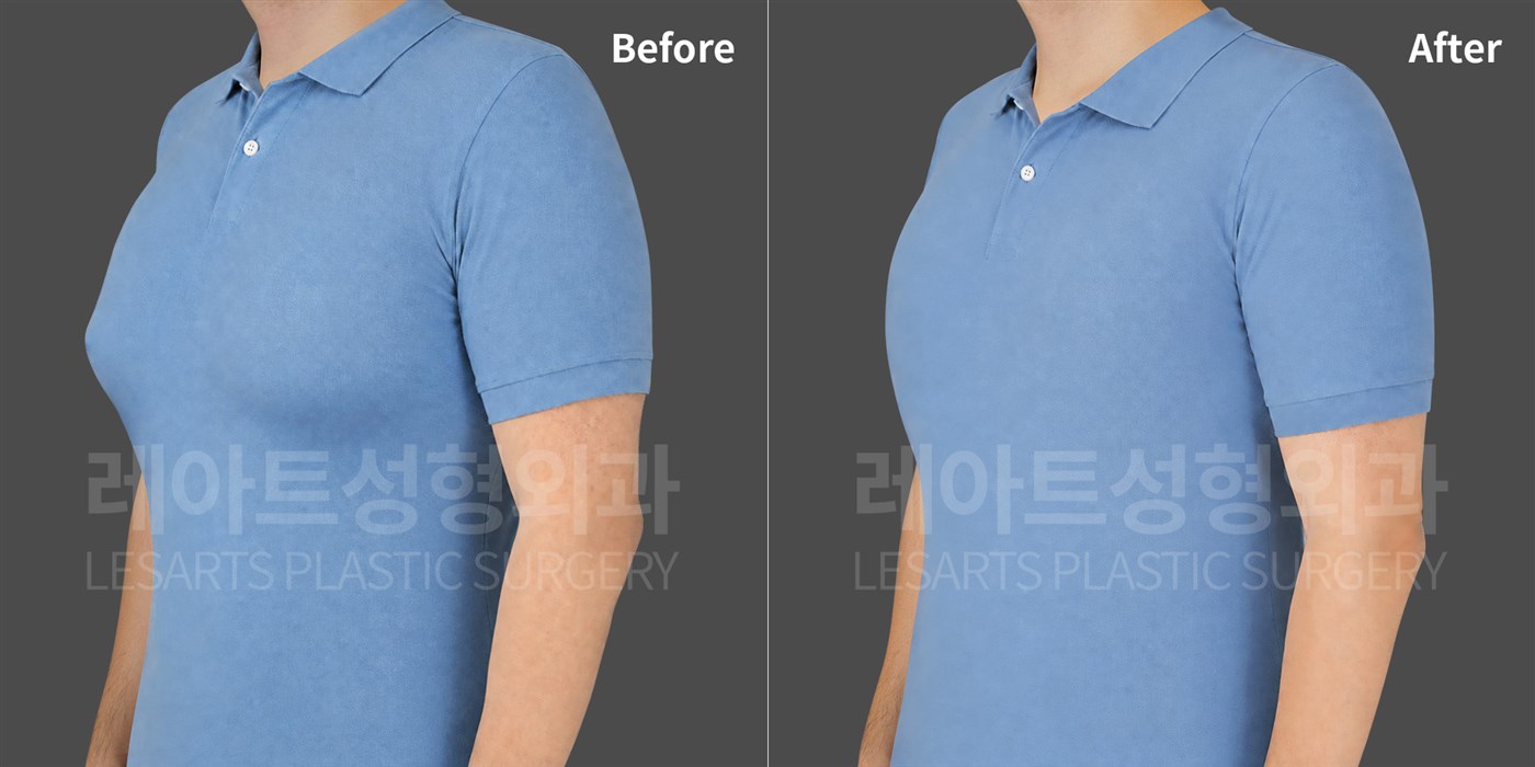 Gynecomastia surgery in a man in his 40s before and 2 weeks after