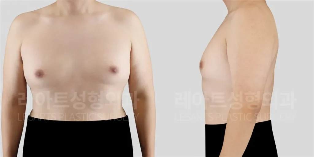 Before gynecomastia surgery, chest protrusion from the front and side in a man in his 40s