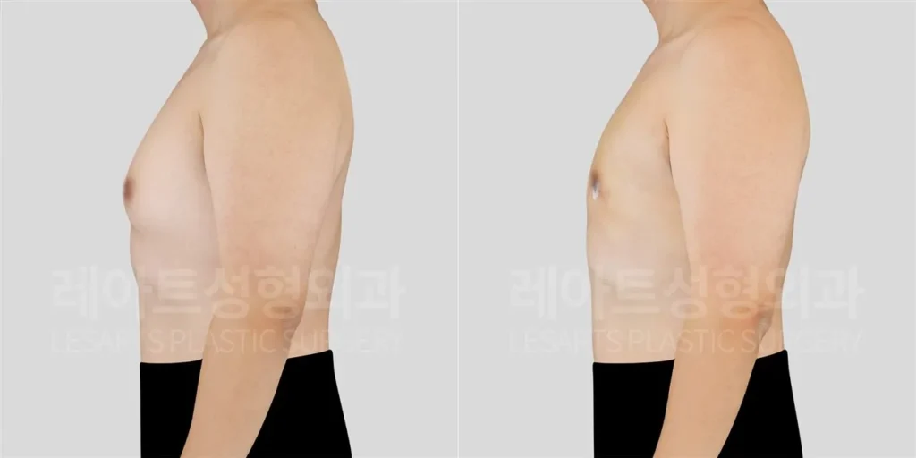 Changes in chest thickness from the side 2 weeks after male gynecomastia surgery