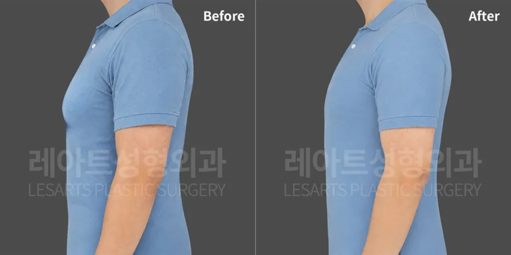 Changes in chest protrusion through a T-shirt after gynecomastia surgery in a man in his 40s, side view