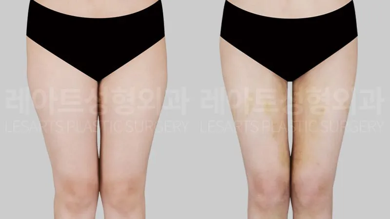 Thigh liposuction in Seoul: can reducing inner and front thigh fat create straighter leg lines?
