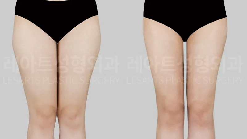 thigh-liposuction-01-thumbnail-260825