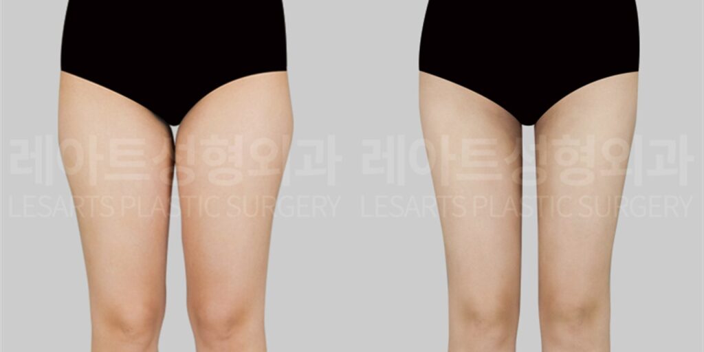 Thigh liposuction in Seoul: worried about scarring and hyperpigmentation? Straighter leg lines at 3 months