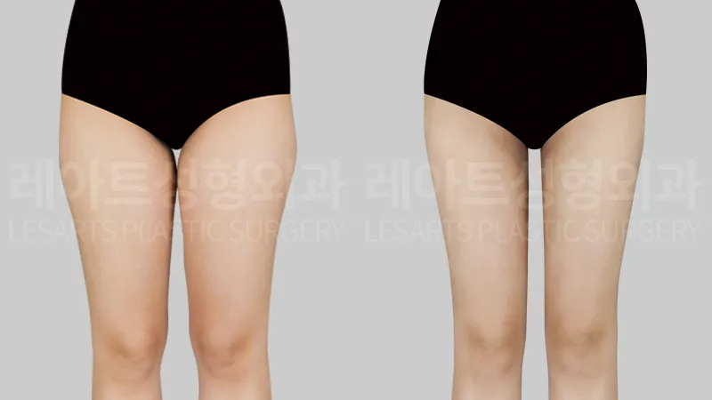 Thigh liposuction before and 3 months after, inner thigh gap and straight leg line from the front