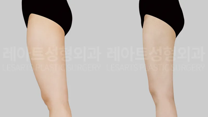 Front thigh volume and leg line from the side 3 months after thigh liposuction