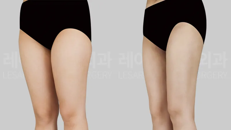 Saddlebags and thigh thickness from the oblique view 3 months after thigh liposuction