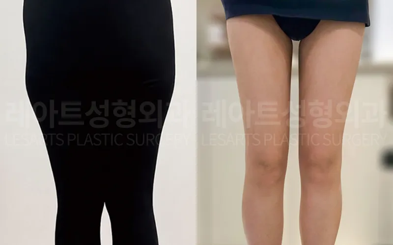Selfie comparison before and 2 months after thigh liposuction
