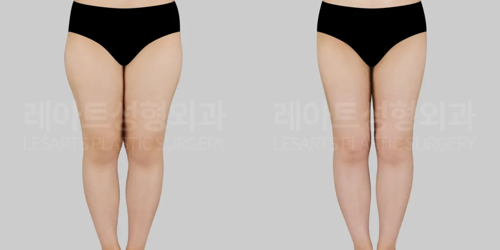 thigh-liposuction-28571-before-after-fornt